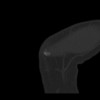 SPORK, NICO - 22.03.1976 - 02.08.2022 - CT obere Extremität - 17:59:07